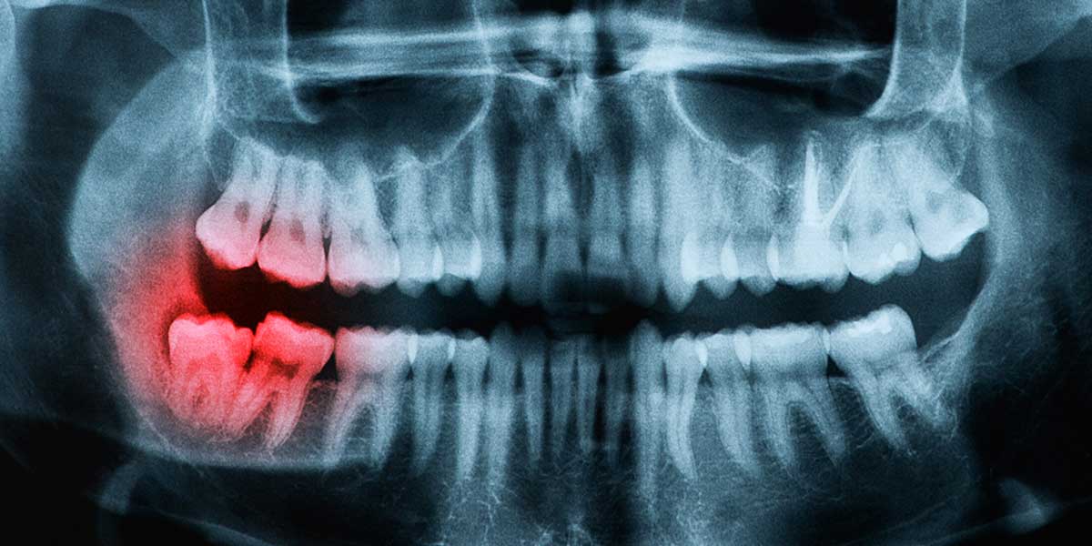 Wisdom Tooth Removal (3rd Molars)