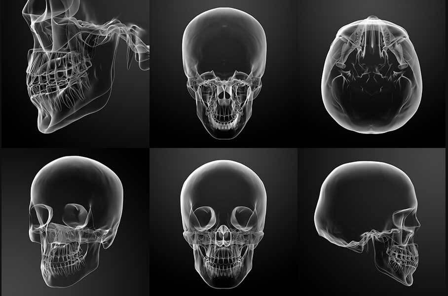 Corrective Jaw Surgery