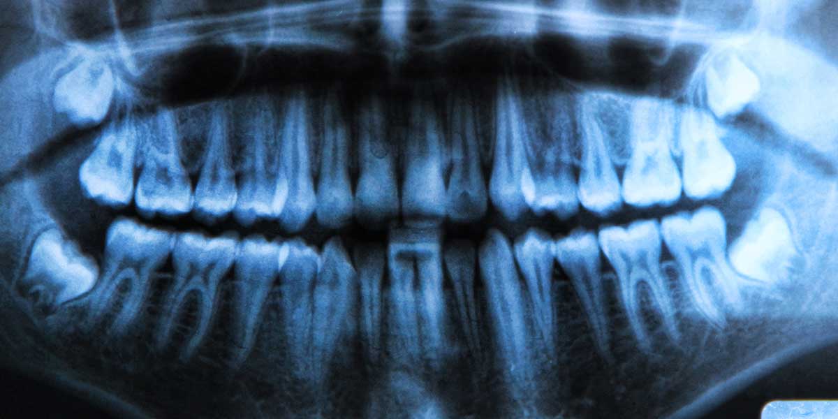 xray showing impacted wisdom teeth