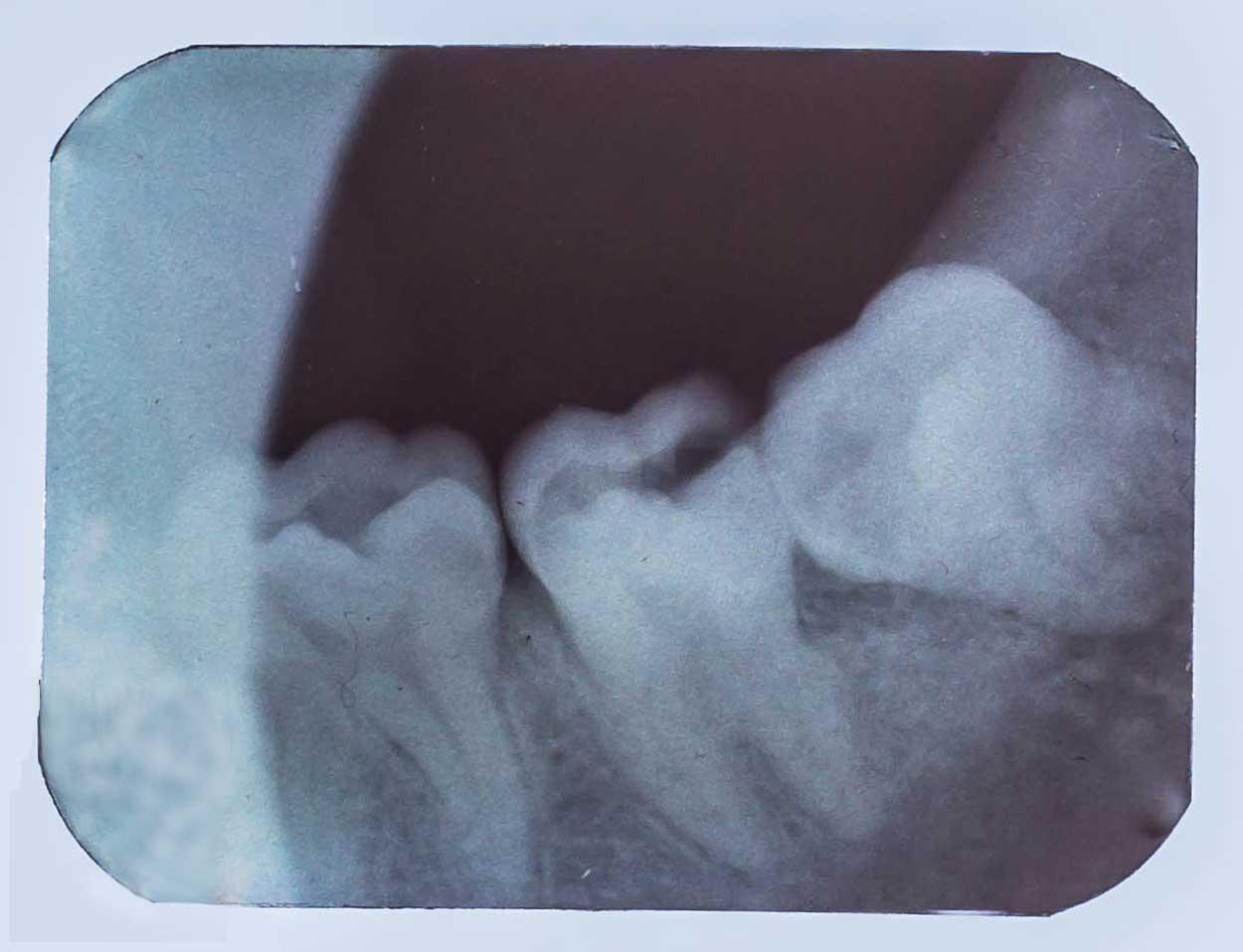 Dental X-ray